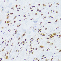 Immunohistochemistry of paraffin-embedded Human gastric cancer using DDB1 Polyclonal Antibody at dilution of 1:100 (40x lens) .