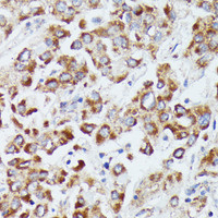 Immunohistochemistry of paraffin-embedded Human liver cancer using DUT Polyclonal Antibody at dilution of 1:100 (40x lens) .