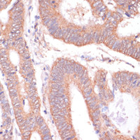 Immunohistochemistry of paraffin-embedded Human colon carcinoma using KCNH2 Polyclonal Antibody at dilution of 1:100 (40x lens) .