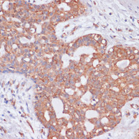Immunohistochemistry of paraffin-embedded Human breast cancer using KCNH2 Polyclonal Antibody at dilution of 1:100 (40x lens) .