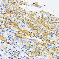 Immunohistochemistry of paraffin-embedded Human liver cancer using MCT1/SLC16A1 Polyclonal Antibody at dilution of 1:100 (40x lens) .