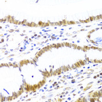 Immunohistochemistry of paraffin-embedded Human gastric cancer using MCM4 Polyclonal Antibody at dilution of 1:100 (40x lens) .