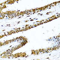 Immunohistochemistry of paraffin-embedded Human breast using NFkB p100 / p52 Polyclonal Antibody at dilution of 1:100 (40x lens) .