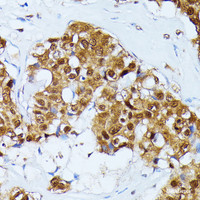 Immunohistochemistry of paraffin-embedded Human esophageal cancer using UBC Polyclonal Antibody at dilution of 1:100 (40x lens) .