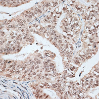 Immunohistochemistry of paraffin-embedded Human endometrium cancer using RBM17 Polyclonal Antibody at dilution of 1:100 (40x lens) .