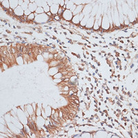 Immunohistochemistry of paraffin-embedded Human colon carcinoma using KIFC1 Polyclonal Antibody at dilution of 1:100 (40x lens) .