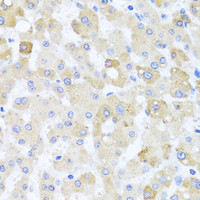 Immunohistochemistry of paraffin-embedded Human liver damage using CETN1 Polyclonal Antibody at dilution of 1:100 (40x lens) .