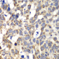 Immunohistochemistry of paraffin-embedded Human esophageal cancer using PARN Polyclonal Antibody at dilution of 1:100 (40x lens) .