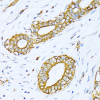 Immunohistochemistry of paraffin-embedded Human breast cancer using VARS Polyclonal Antibody at dilution of 1:100 (40x lens) .