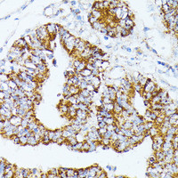 Immunohistochemistry of paraffin-embedded Human colon carcinoma using TRAP1 Polyclonal Antibody at dilution of 1:100 (40x lens) .