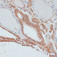 Immunohistochemistry of paraffin-embedded Human thyroid cancer using MYCBP Polyclonal Antibody at dilution of 1:100 (40x lens) .