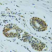 Immunohistochemistry of paraffin-embedded Human breast cancer using NHEJ1 Polyclonal Antibody at dilution of 1:100 (40x lens) .