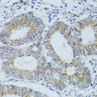 Immunohistochemistry of paraffin-embedded Human colon carcinoma using DNAJC19 Polyclonal Antibody at dilution of 1:100 (40x lens) .