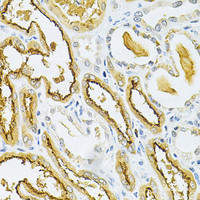 Immunohistochemistry of paraffin-embedded Human kidney cancer using GLRX Polyclonal Antibody at dilution of 1:200 (40x lens) .