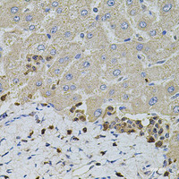 Immunohistochemistry of paraffin-embedded Human liver damage using S100A12 Polyclonal Antibody at dilution of 1:100 (40x lens) .