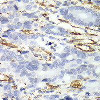 Immunohistochemistry of paraffin-embedded Human gastric cancer using CALD1 Polyclonal Antibody at dilution of 1:100 (40x lens) .