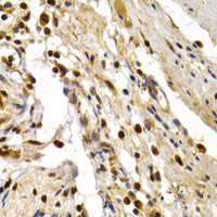 Immunohistochemistry of paraffin-embedded Human colon damage using TFDP1 Polyclonal Antibody at dilution of 1:200 (40x lens) .