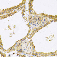 Immunohistochemistry of paraffin-embedded Human thyroid cancer using FHL1 Polyclonal Antibody at dilution of 1:100 (40x lens) .