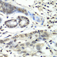 Immunohistochemistry of paraffin-embedded Human gastric cancer using HIF1AN Polyclonal Antibody at dilution of 1:100 (40x lens) .