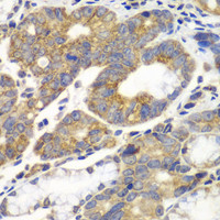 Immunohistochemistry of paraffin-embedded Human gastric cancer using PFKM Polyclonal Antibody at dilution of 1:100 (40x lens) .