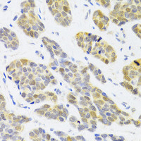 Immunohistochemistry of paraffin-embedded Human breast cancer using RFC4 Polyclonal Antibody at dilution of 1:100 (40x lens) .