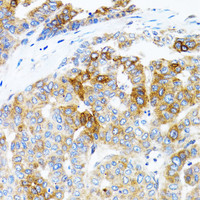 Immunohistochemistry of paraffin-embedded Human liver cancer using STAT3 Polyclonal Antibody at dilution of 1:100 (40x lens) .