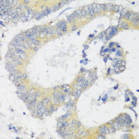 Immunohistochemistry of paraffin-embedded Human colon carcinoma using Snail Polyclonal Antibody at dilution of 1:100 (40x lens) .