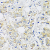 Immunohistochemistry of paraffin-embedded Human breast cancer using Snail Polyclonal Antibody at dilution of 1:100 (40x lens) .