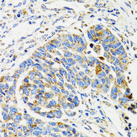 Immunohistochemistry of paraffin-embedded Human esophageal cancer using SH2B1 Polyclonal Antibody at dilution of 1:100 (40x lens) .