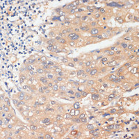 Immunohistochemistry of paraffin-embedded Human liver cancer using WNK3 Polyclonal Antibody at dilution of 1:100 (40x lens) .