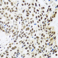 Immunohistochemistry of paraffin-embedded Human lung cancer using FUBP1 Polyclonal Antibody at dilution of 1:100 (40x lens) .