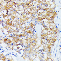 Immunohistochemistry of paraffin-embedded Human mammary cancer using ECE1 Polyclonal Antibody at dilution of 1:100 (40x lens) .