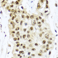 Immunohistochemistry of paraffin-embedded Human lung cancer using TET2 Polyclonal Antibody at dilution of 1:100 (40x lens) .