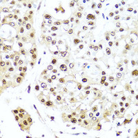 Immunohistochemistry of paraffin-embedded Human colon carcinoma using TET2 Polyclonal Antibody at dilution of 1:100 (40x lens) .