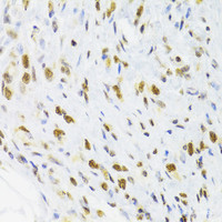 Immunohistochemistry of paraffin-embedded Human gastric cancer using DOK1 Polyclonal Antibody at dilution of 1:100 (40x lens) .