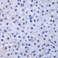 Immunohistochemistry of paraffin-embedded Human liver cancer using GSTP1 Polyclonal Antibody at dilution of 1:200 (40x lens) .