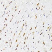 Immunohistochemistry of paraffin-embedded Human gastric cancer using RUVBL1 Polyclonal Antibody at dilution of 1:100 (40x lens) .