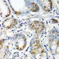 Immunohistochemistry of paraffin-embedded Human colon carcinoma using CRYAA Polyclonal Antibody at dilution of 1:200 (40x lens) .