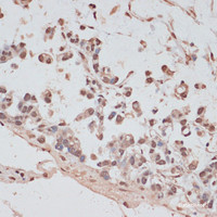 Immunohistochemistry of paraffin-embedded Human gastric cancer using PRPF31 Polyclonal Antibody at dilution of 1:100 (40x lens) .