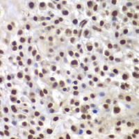 Immunohistochemistry of paraffin-embedded Mouse osteosarcoma using SMARCB1 Polyclonal Antibody at dilution of 1:200 (40x lens) .