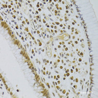 Immunohistochemistry of paraffin-embedded Human colon cancer using HEXIM1 Polyclonal Antibody at dilution of 1:100 (40x lens) .