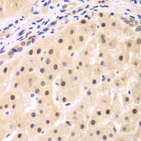 Immunohistochemistry of paraffin-embedded Human liver cancer using NFKBIB Polyclonal Antibody at dilution of 1:200 (40x lens) .