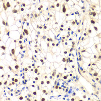Immunohistochemistry of paraffin-embedded Human kidney cancer using NFKBIB Polyclonal Antibody at dilution of 1:200 (40x lens) .