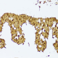 Immunohistochemistry of paraffin-embedded Human mammary cancer using SKIL Polyclonal Antibody at dilution of 1:100 (40x lens) .