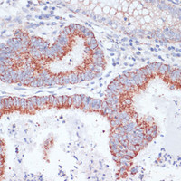 Immunohistochemistry of paraffin-embedded Human colon carcinoma using TFRC Polyclonal Antibody at dilution of 1:100 (40x lens) .