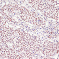 Immunohistochemistry of paraffin-embedded Human cervix cancer using SNRNP70 Polyclonal Antibody at dilution of 1:100 (40x lens) .