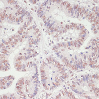 Immunohistochemistry of paraffin-embedded Human colon carcinoma using SNRNP70 Polyclonal Antibody at dilution of 1:100 (40x lens) .