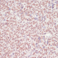 Immunohistochemistry of paraffin-embedded Human oophoroma using SNRNP70 Polyclonal Antibody at dilution of 1:100 (40x lens) .