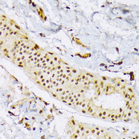 Immunohistochemistry of paraffin-embedded Human mammary cancer using SRSF3 Polyclonal Antibody at dilution of 1:100 (40x lens) .