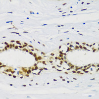 Immunohistochemistry of paraffin-embedded Human breast cancer using CIRBP Polyclonal Antibody at dilution of 1:100 (40x lens) .